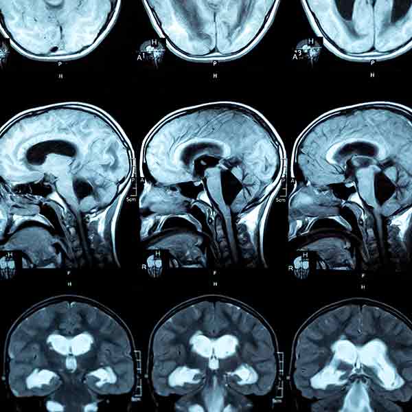 Healing Hydrocephalus: Draining the brain with science!